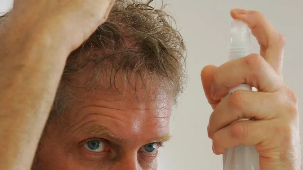 начальное облысение начальное облысение